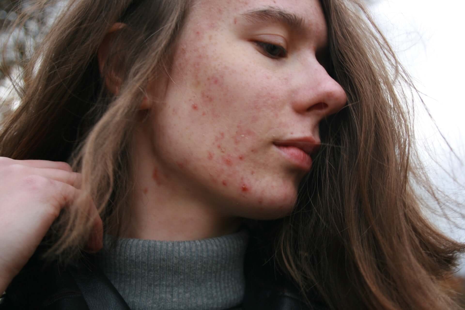 A white woman with long brown hair and light acne on her face.